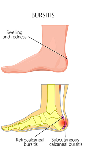 bursa pain heel